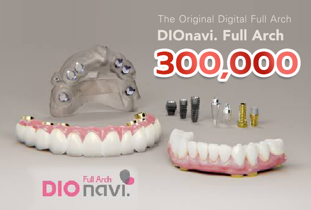 Full Arch Restoration รากฟันเทียม