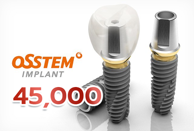 Osstem Implant รากฟันเทียม
