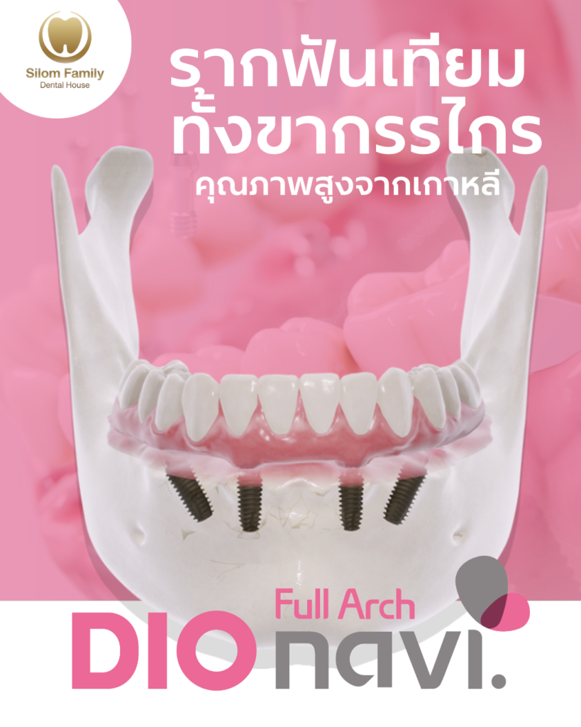 DIO NAVI Full Arch รากฟันเทียมคุณภาพสูง รากฟันเทียม ทั้งขากรรไกร คุณภาพสูงจากเกาหลี